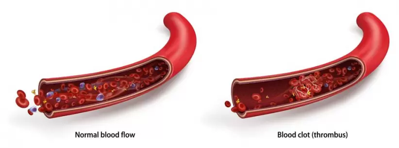 Flujo normal de sangre vs coágulos sanguíneos