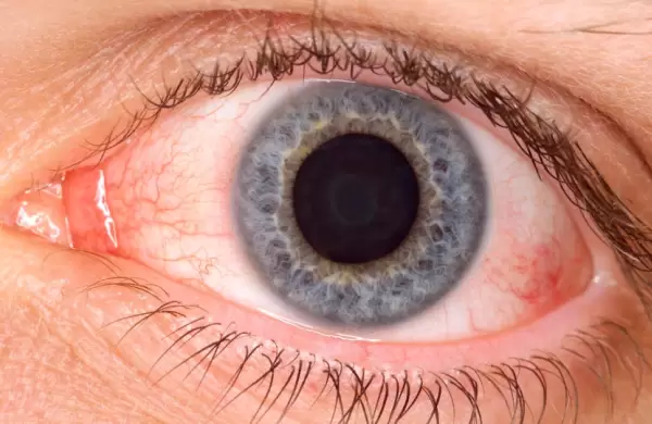 Qué saber sobre arcturus, la nueva variente del Covid asociada con conjuntivitis