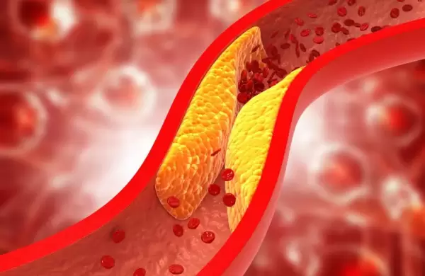 Revolucionar la cardiologa? Frmaco en ensayo clnico promete erradicar el colesterol malo con una sola pastilla